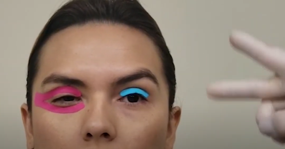 Diferença dos dois tipos de bandagem no orbicular dos olhos para selar: alternar as aplicações – Motility Oral 