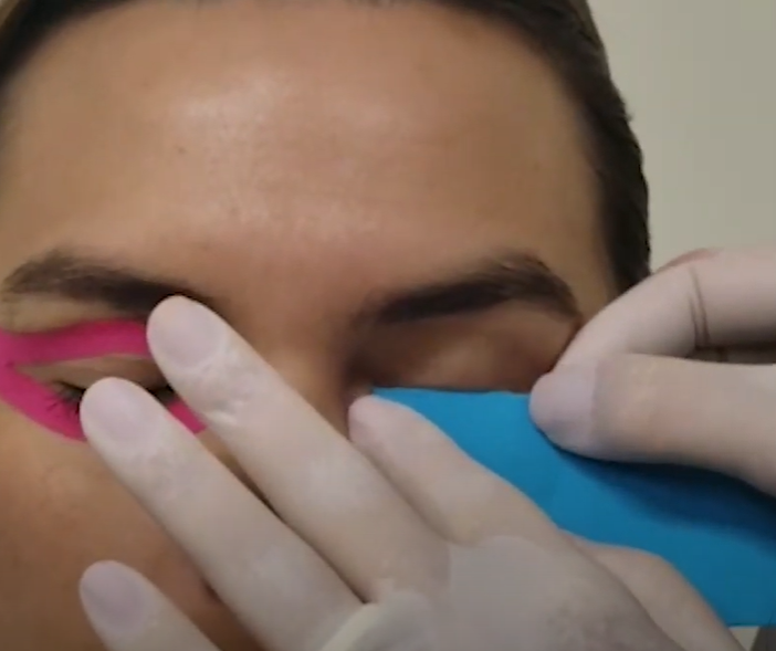 Primeiro passo: fazer a medida padrão da bandagem do orbicular dos olhos – Motility Oral 