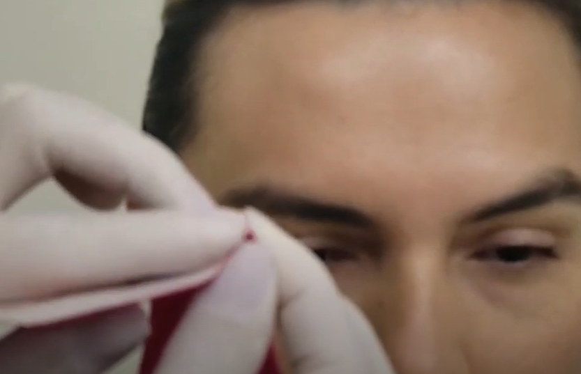 Primeiro passo para cortar: pinçar a bandagem no orbicular dos olhos – Motility Oral 