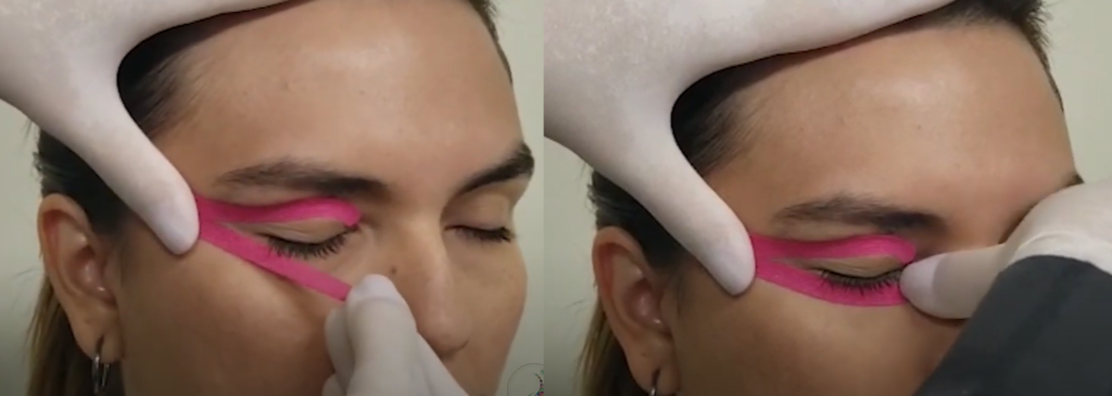 Quinto passo para colar: aplicar a bandagem embaixo do orbicular dos olhos, contornando os cílios – Motility Oral 