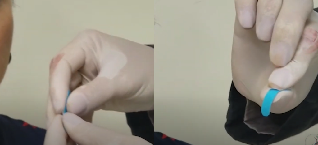 Segundo passo: cortar a proteção da bandagem do orbicular dos olhos ao meio, para colar – Motility Oral 