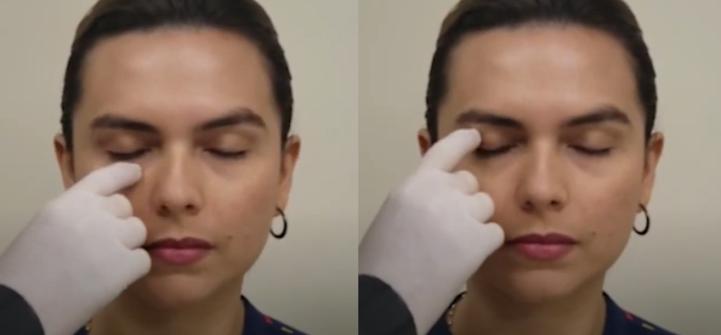 Segundo passo para cortar: puxar pra baixo e pra cima a bandagem no orbicular dos olhos – Motility Oral 