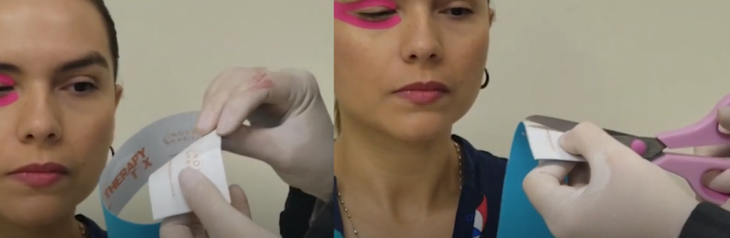 Segundo passo: pinçar e cortar a bandagem do orbicular dos olhos – Motility Oral 