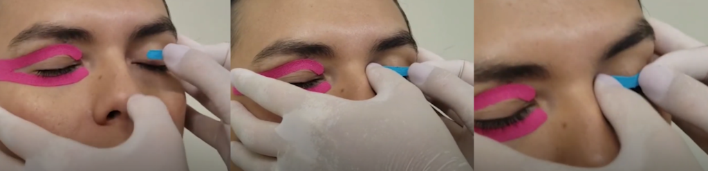 colar a primeira parte da bandagem no orbicular dos olhos, bem rente aos cílios – Motility Oral 