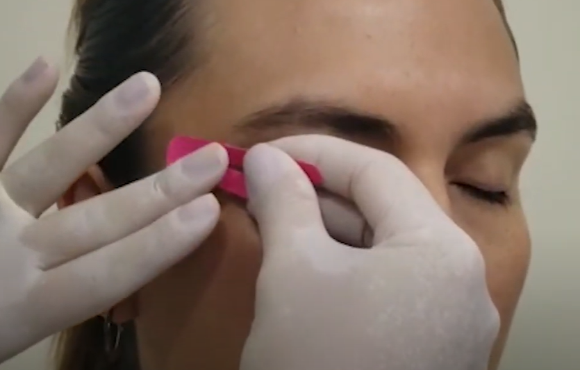 Terceiro passo: colar a bandagem na região das têmporas dos olhos – Motility Oral 