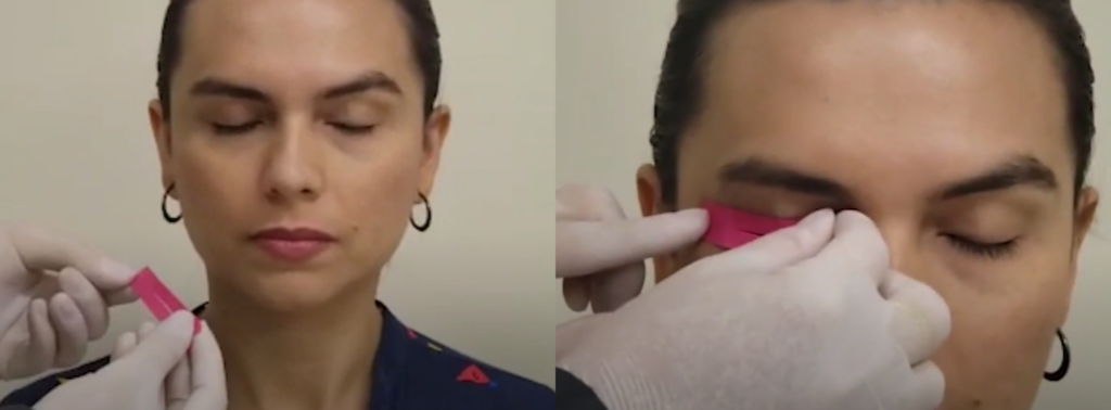 Terceiro passo: cortar uma tirinha fina a bandagem do orbicular dos olhos – Motility Oral 