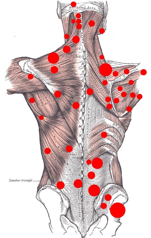 Trigger points ou pontos-gatilho 